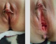 pussy gape before and after