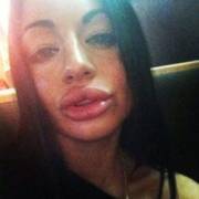Lips injections