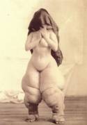 Elephantiasis