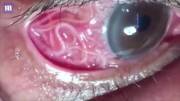 15cm long parasite is removed from mans eye