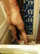 Here. Have a spotty butt.