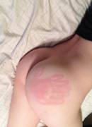 This girl got spanked such that it looks as though her spanker has an extra finger [x-post from /r/mildlyinteresting/]